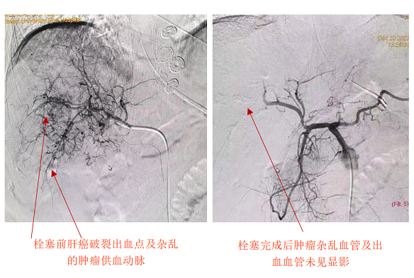 肝癌破裂大出血命悬一线——啪啪啦
急诊介入止血化险为夷